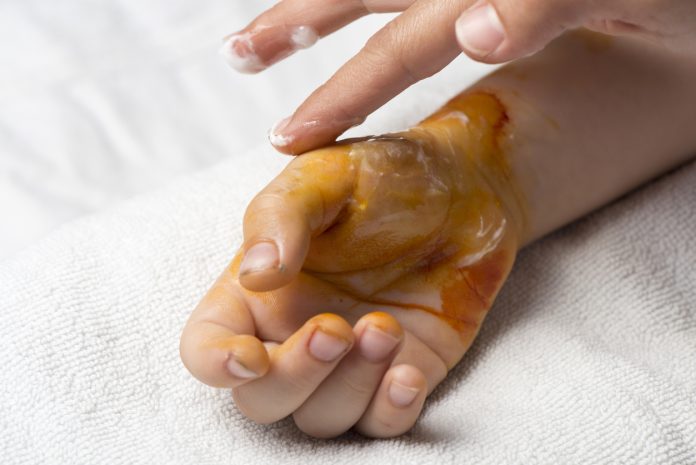 أسرع-طريقة-لعلاج-حروق-اليد-من-الفرن-وكيفية-إزالة-علامات-الحروق-نهائيا