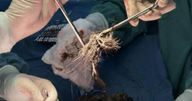أطباء صينيون يزيلون كرة شعر تزن 2 كيلو من معدة فتاة 