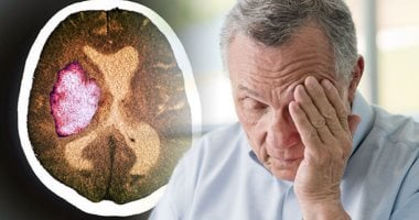 أداة ذكاء اصطناعي قد تساعد نصف مرضى السكتة الدماغية على التعافي