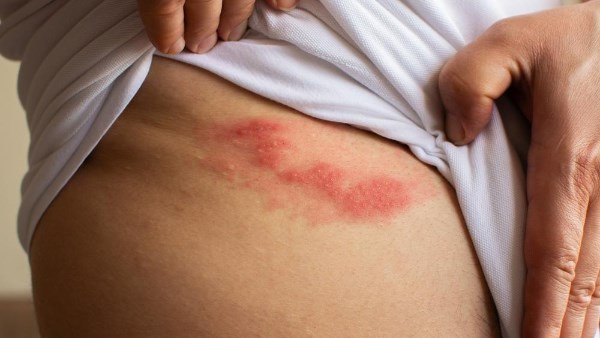 الحزام الناري: مرض فيروسي يصيب الأعصاب والجلد وأسبابه وأعراضه الحزام الناري: مرض فيروسي يصيب الأعصاب والجلد وأسبابه وأعراضه