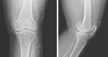 حالة طبية مثيرة للجدل تكشف سر وجود مئات الخيوط الذهبية في ركبة امرأة كورية حالة طبية مثيرة للجدل تكشف سر وجود مئات الخيوط الذهبية في ركبة امرأة كورية