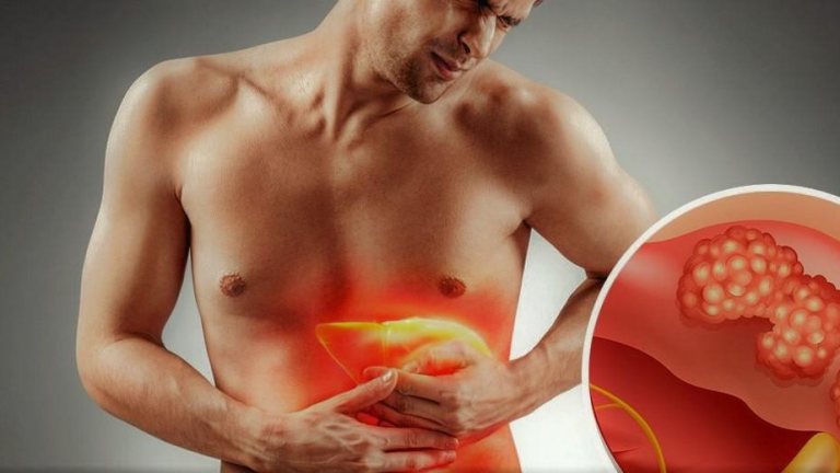 أعراض فيروس الالتهاب الكبدي B أعراض فيروس الالتهاب الكبدي B