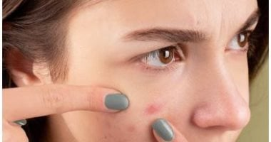 6 نصائح للتعامل مع حب الشباب خلال فترة المراهقة، وأهمها تجنب لمس الحبوب 